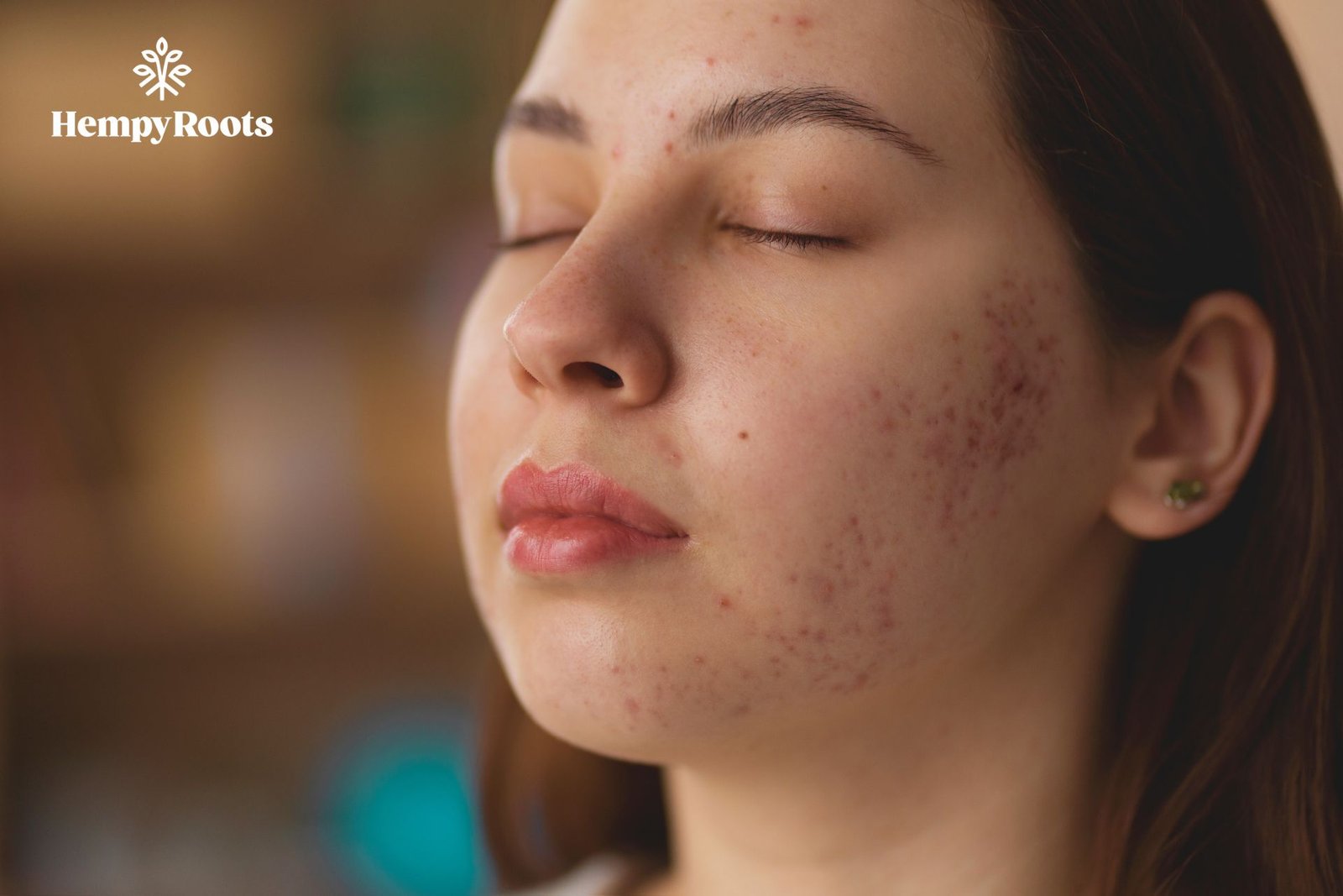 CBD for Eczema, Psoriasis and Rosacea